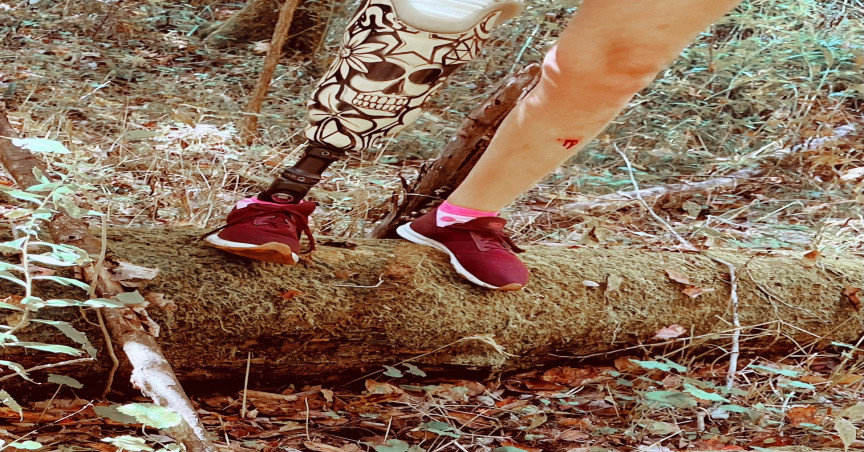 Woman wearing her prosthetic leg