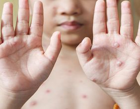 Latest on monkeypox outbreak: Which countries have reported it so far?