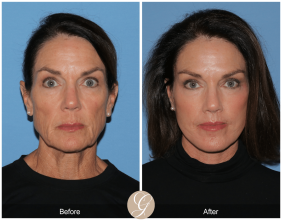 Preservation Facelift the Next Generation of Deep Plane Facelift Technique