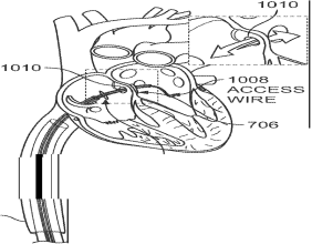 Retriever Medical Announces Notice of Allowance for Innovative Occlusion Device