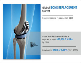 Bone Replacement Market on Track for $25.20 Billion by 2030, Growing at 5.90% CAGR