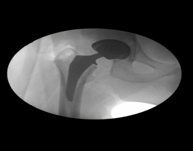 Corin Announces First Clinical Use of Icona™ Femoral Stem