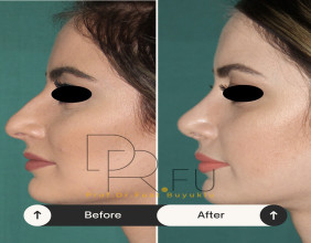 Professor Fuat Buyuklu: 10 Things To Know Before Rhinoplasty