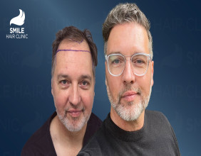 Revolutionizing Confidence: Turkey Emerges as a Global Hub for Hair Transplantation