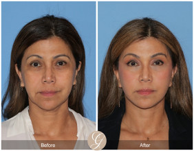Dr. Kevin Sadati presented his Preservation Deep Plane Facelift Technique at the IMCAS in Paris