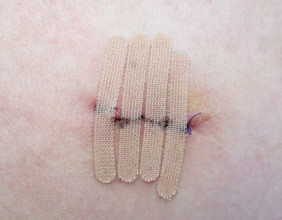 Stem Health Plus Provides Expert Care for Those Experiencing Post-Surgical Healing