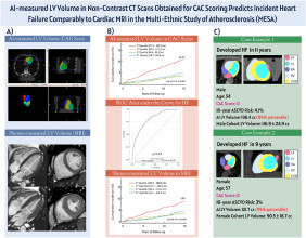 AI-Powered CT Chamber Volumetry Predicts Heart Failure Risk As Accurately As MRI, New Study Shows