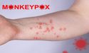Monkeypox: Which is the worst hit country?