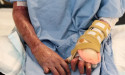  Doctors brace for Aust Day burns spike 
