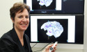 Smartwatch study explores better living with epilepsy