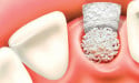 Surging Demand for Dental Implant Procedures Drives Growth in Europe's Dental Bone Graft Substitute Market Expansion 