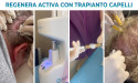 Nuova frontiera del trapianto di capelli: studi affermano risultati permanenti e positivi con Regenera Activa