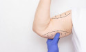  Dr. Penelope Treece, MD, Enlightens the Public on Effective Arm Contouring Solutions 