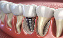 Value-Based Dental Implants in Asia-Pacific Fuel Market Growth to Reach $2.5B by 2030 