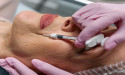 Dr. Penelope Treece, MD, Highlights the Remarkable Advantages of the Dermal Filler Radiesse