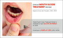 Global Mouth Ulcers Treatment Market to Reach $2.37 Billion by 2030: Allied Market Research