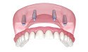  Radiant Smiles Dental Care Announces All On 4 Dental Implants in Perth 