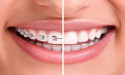Exeter Smiles Enhances Orthodontics in Allentown with Advanced Invisalign Services
