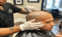 SMP Treatment- New Way for Hair Treatment for Australians