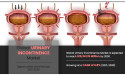 Urinary Incontinence Market Size, Share, Competitive Landscape and Trend Analysis Report Forecast - 2023-2030