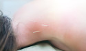 Introducing Dry Needling for Effective Treatment of Musculoskeletal Conditions