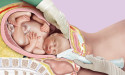  The Tydeman® Tube – An Innovative Medical Device To Facilitate Delivery Of The Impacted Fetal Head At Caesarean Section 
