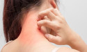  Pruritus Therapeutics Market Updates 2024 : Current Trends, Challenges, and Future Outlook 2021-2031 