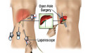 Laparoscopic and Open Hernia Mesh Repair Surgery Market Report, Size, Share Report 2024-2032