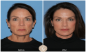 Understanding the Recovery Process After a Preservation Facelift