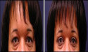 Dr. Sam Speron Shows the Way with his Modern Blepharoplasty Surgery
