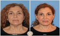 New Trends in Plastic Surgery & Aesthetic Medicine in 2025