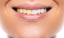 Comparing In-Office Teeth Whitening with Over-the-Counter Kits: What Sets Them Apart