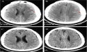 Chinese Neurosurgical Journal Reports Recovery from Subacute Subdural Hematoma using Non-Surgical Therapy