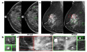 Artificial intelligence-based diagnosis of breast cancer by mammography microcalcification