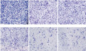 Chinese Neurosurgical Journal Report Identifies FAM111B as Key Molecular Driver of Glioma Progression