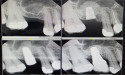Greater New York Dental Meeting 2024 - Dental Implants, Soft Tissue & Bone Grafts to Rehabilitate Oral Health and Smile