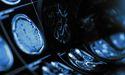  AstraZeneca Drug Advances Spark Strong Market Attention 