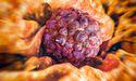  Radiopharm (ASX:RAD) unveils encouraging interim data for F-18 Pivalate in brain metastases 