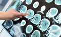  Actinogen Medical Enrolls Final Patient For Alzheimer’s Treatment Trial 