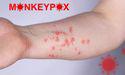  Monkeypox cases rising in Australia; Will healthcare giants be impacted? 